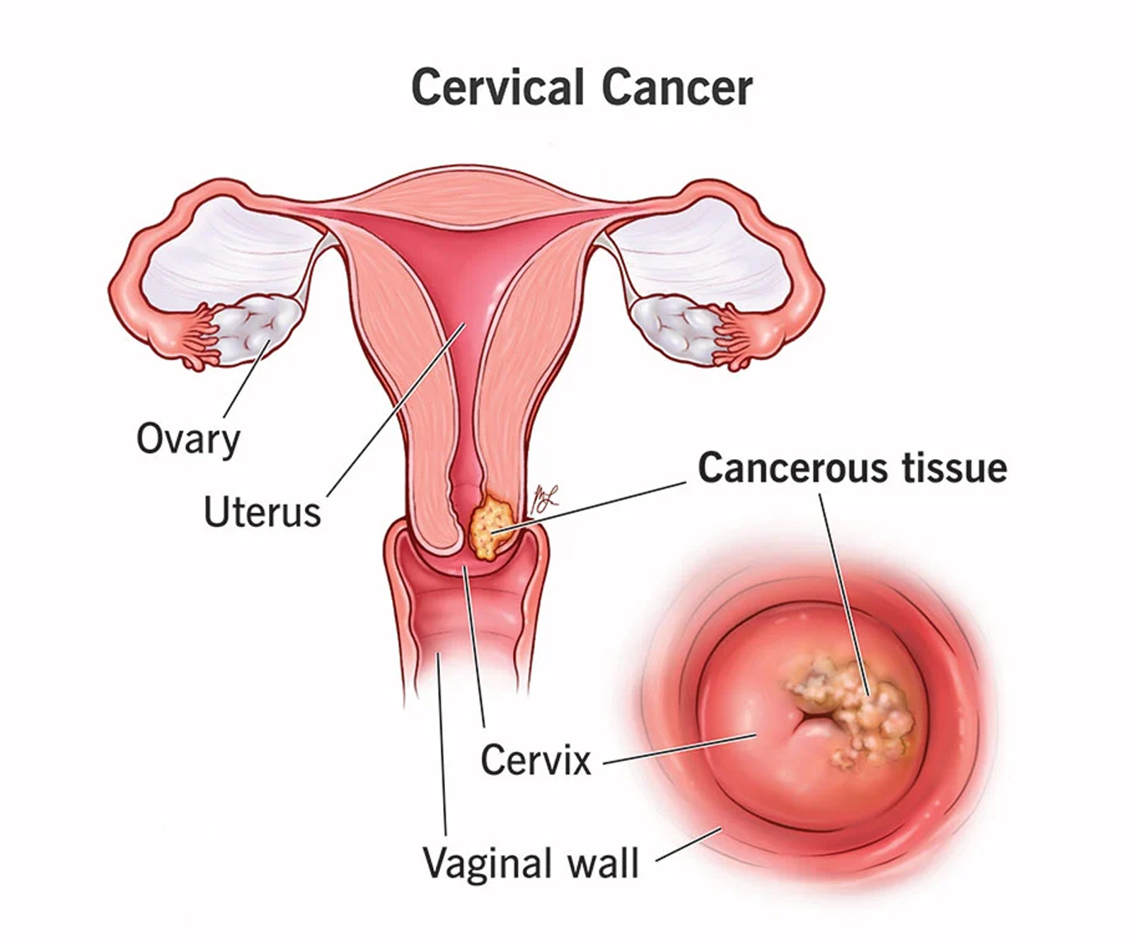 cervical cancer treatment in Nagpur