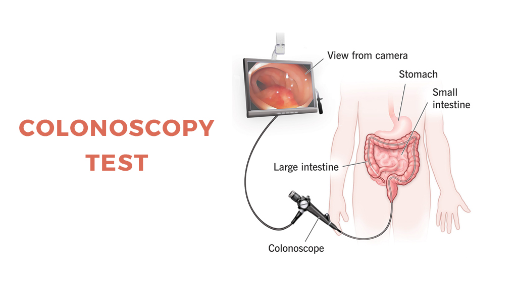 Colonoscopy Test: Everything You Need To Know