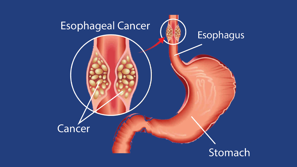 Esophageal Cancer Overview: A Comprehensive Guide