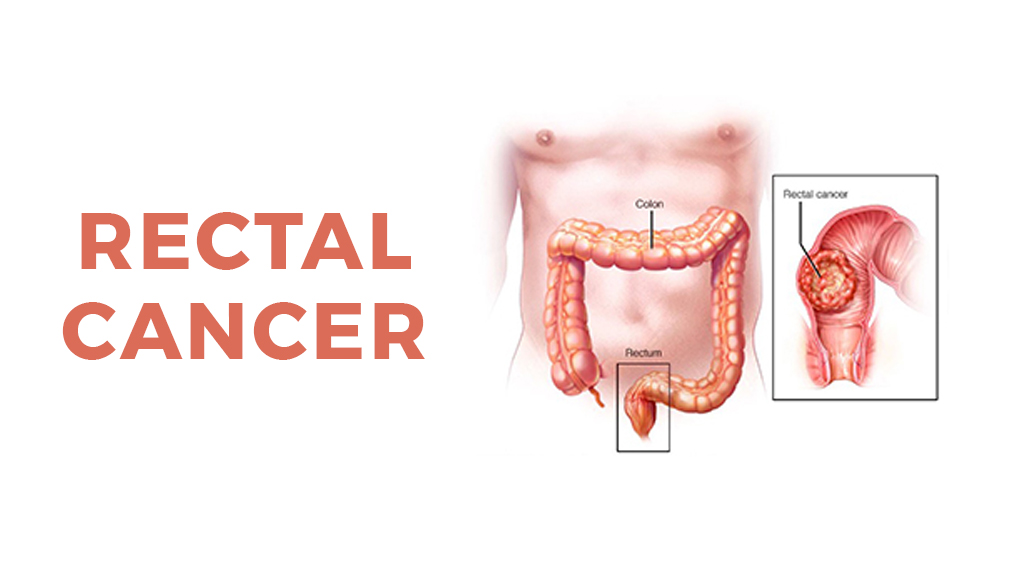 Rectal Cancer: Symptoms, Causes, Diagnosis, Treatment